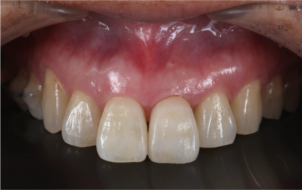 前歯一本のインプラント治療（術後）