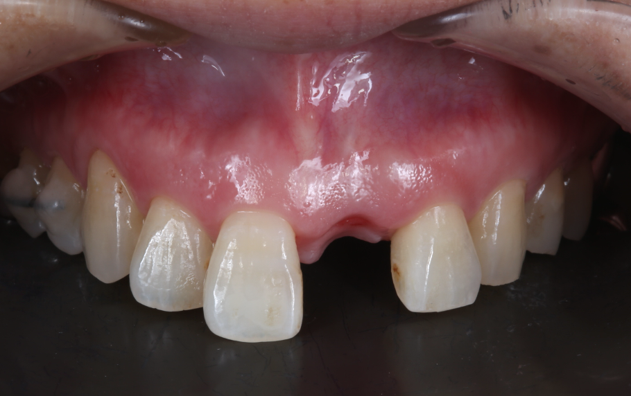 前歯一本のインプラント治療（術前）