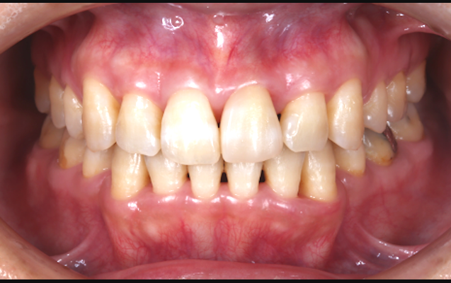 歯牙移植（術後）