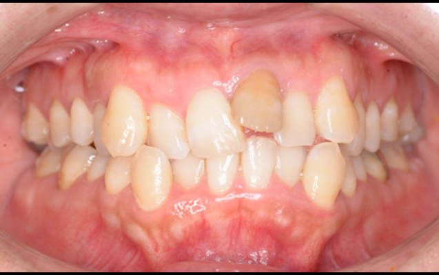 歯牙移植（術前）