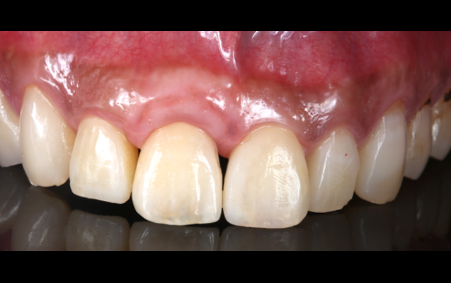 前歯部GBR（術後）