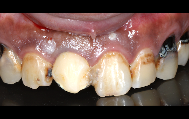 前歯部GBR（術前）