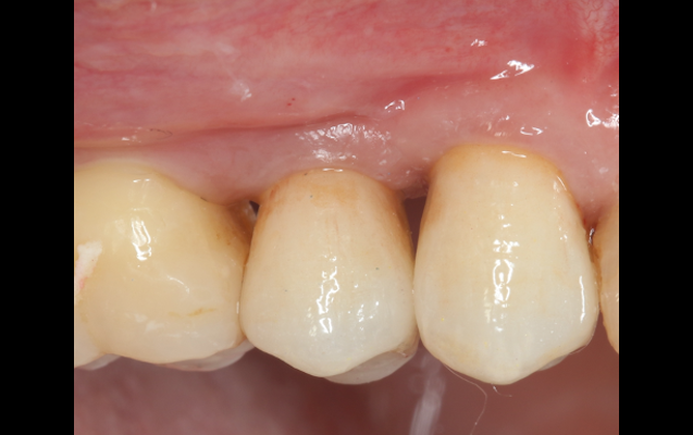 上顎奥歯の骨増生（術後）