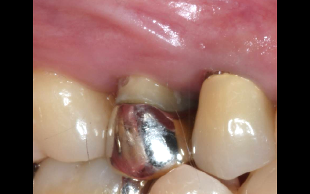 上顎奥歯の骨増生（術前）