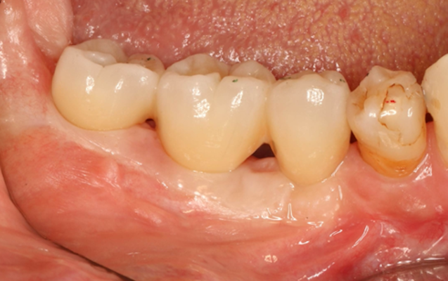 臼歯部GBR（術後）