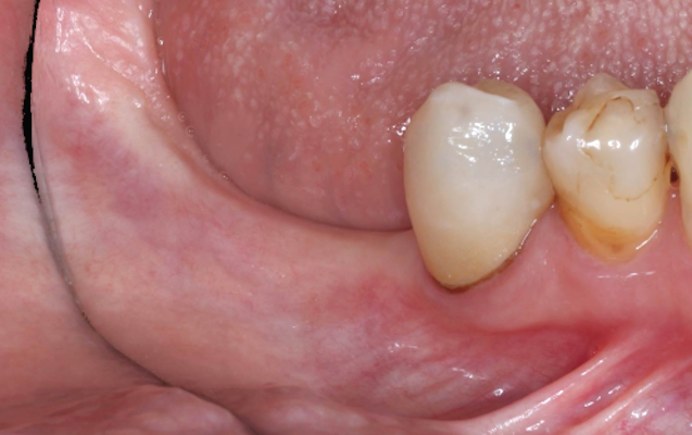 臼歯部GBR（術前）