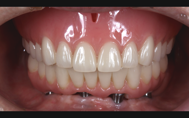 全く歯がない場合の治療（術後）