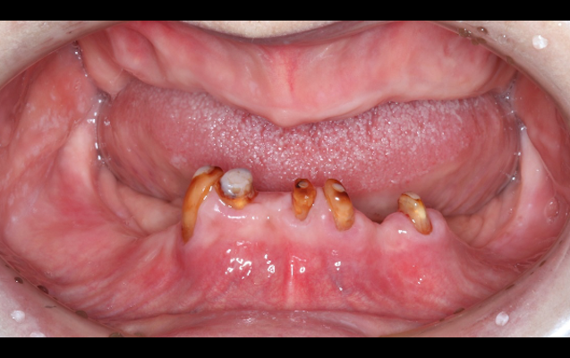 全く歯がない場合の治療（術前）