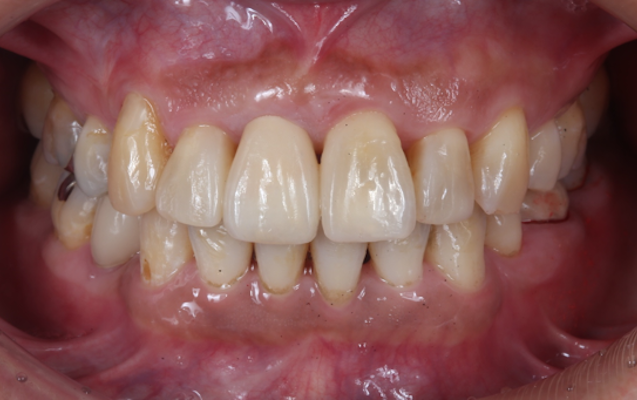 矯正併用インプラント（術後）