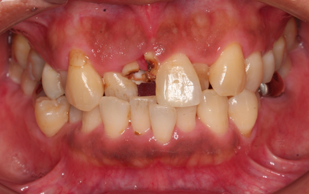 矯正併用インプラント（術前）