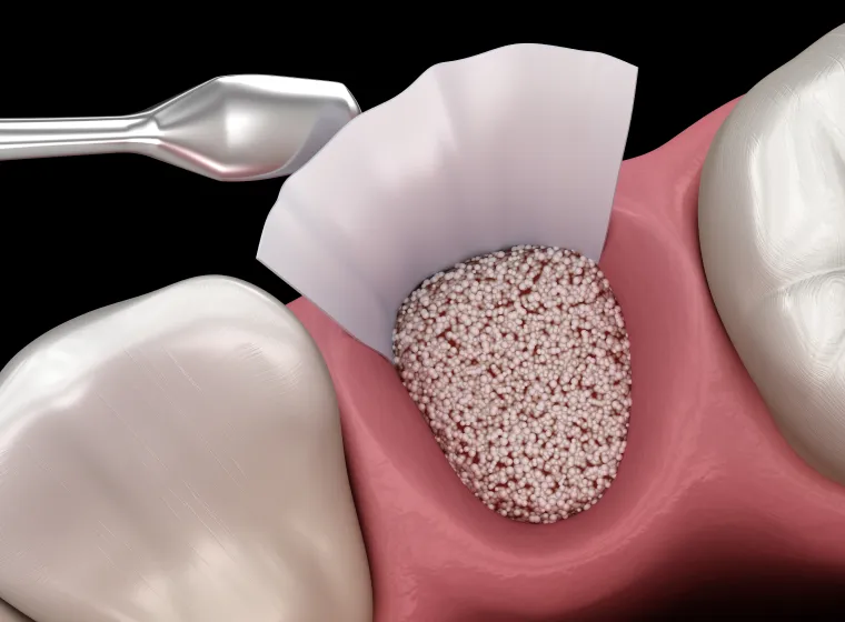GBR法（骨誘導再生法）