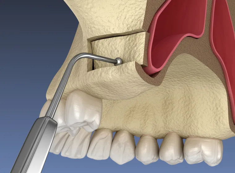 サイナスリフト（上顎洞挙上術）