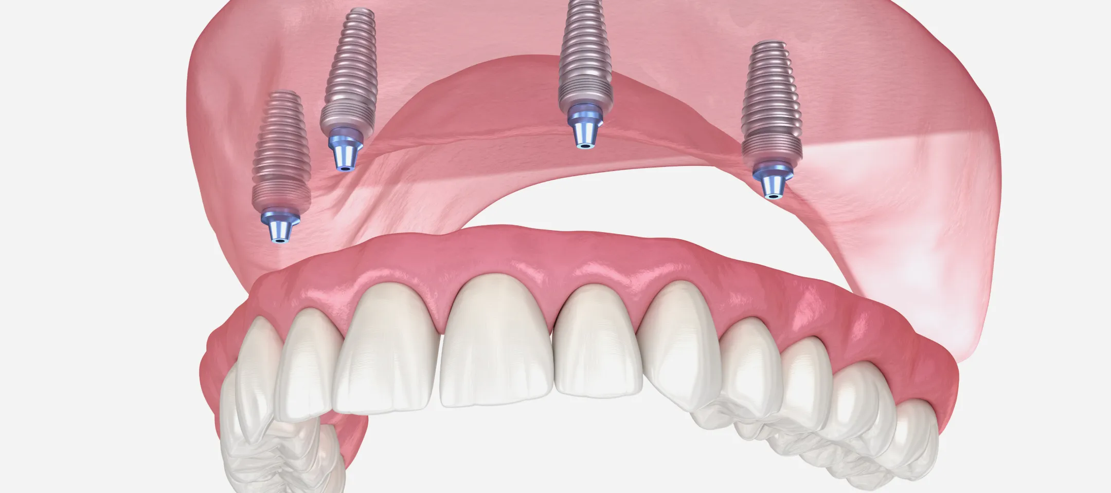 入れ歯に頼らず“固定式”で快適な生活を