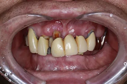 重度虫歯からの全顎インプラント治療 before