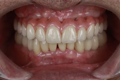 重度虫歯からの全顎インプラント治療 after