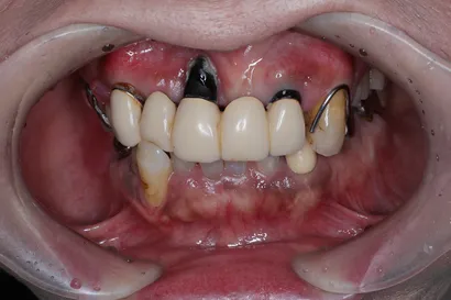 インプラントと矯正を併用した咬合再構成治療 before