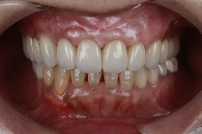 インプラントと矯正を併用した咬合再構成治療 after