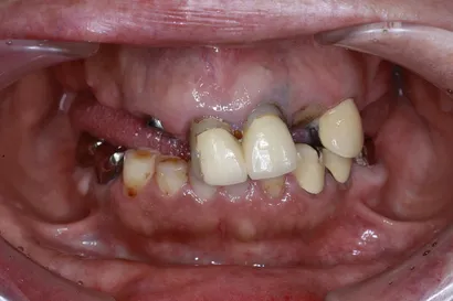 インプラントと矯正を使用した咬合再構成治療 before