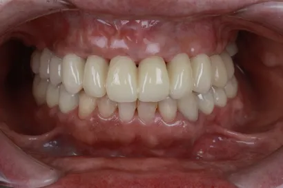 インプラントと矯正を使用した咬合再構成治療 after