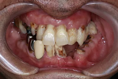 重度虫歯からの全顎インプラント治療 before