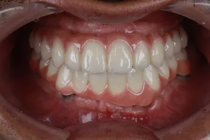 重度虫歯からの全顎インプラント治療 after