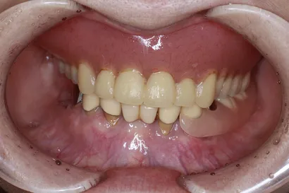 入れ歯からの全顎インプラント治療 before