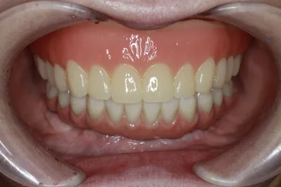 入れ歯からの全顎インプラント治療 after