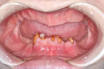 入れ歯からの全顎インプラント治療 before