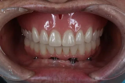 入れ歯からの全顎インプラント治療 after
