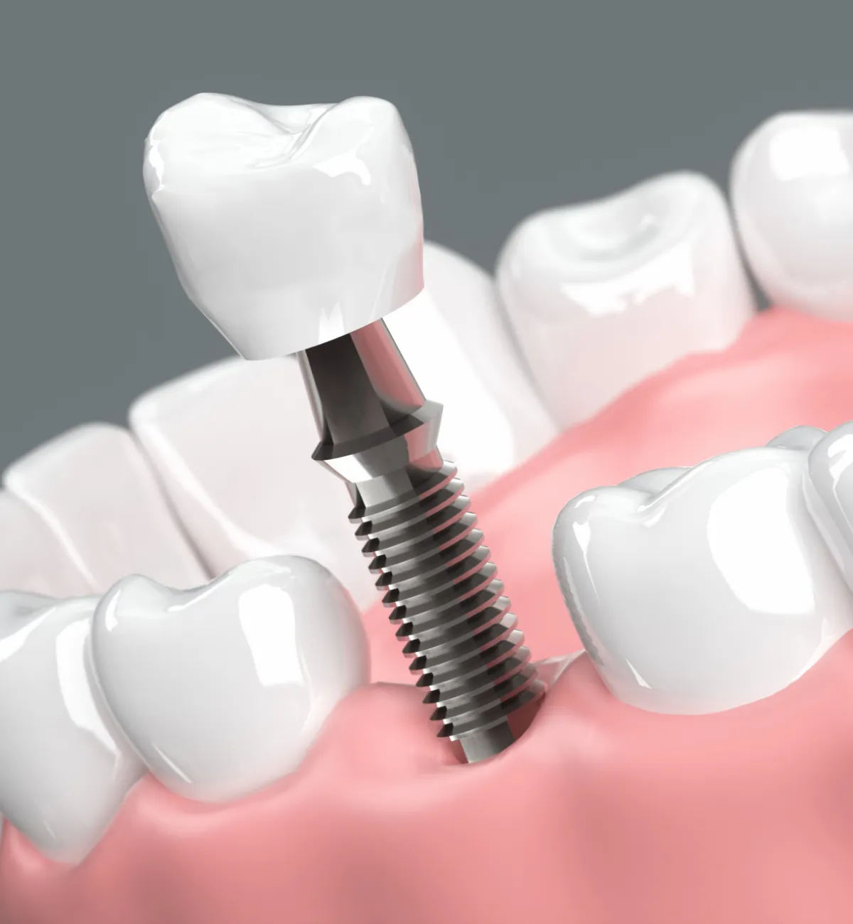 入れ歯・ブリッジ・インプラント オールオンフォーとの違い