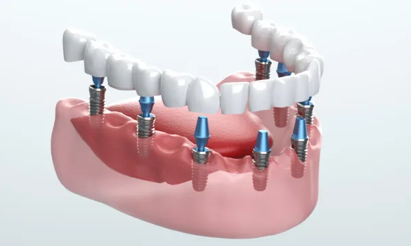 インプラント埋入・当日仮歯装着