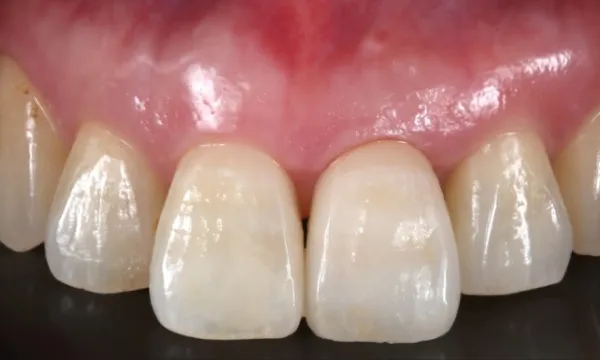 最終的な人工歯の装着