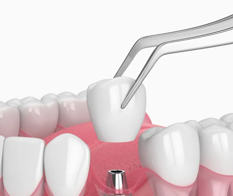 抜歯即時インプラントで機能を早期に回復