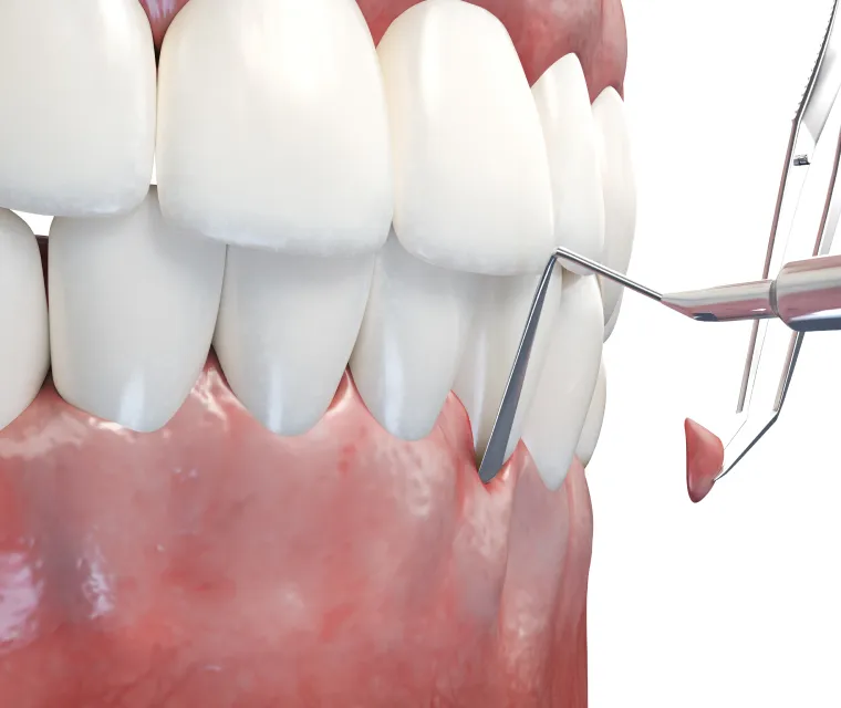 歯ぐきと骨の再生を考慮した審美的なアプローチ