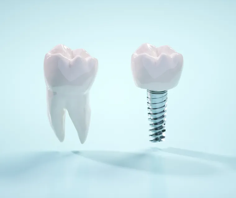 残せる歯を最大限に活かし、補綴で修復