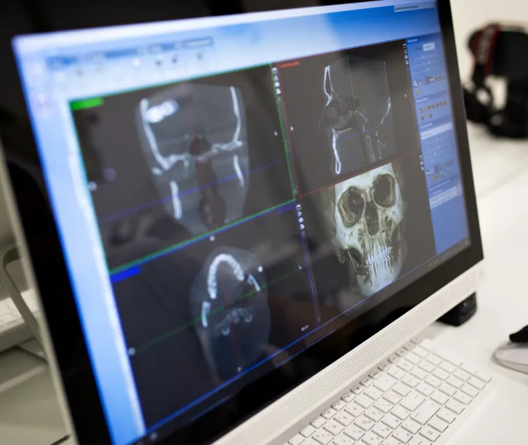 全顎的な補綴設計で噛み合わせと美しさを再構築