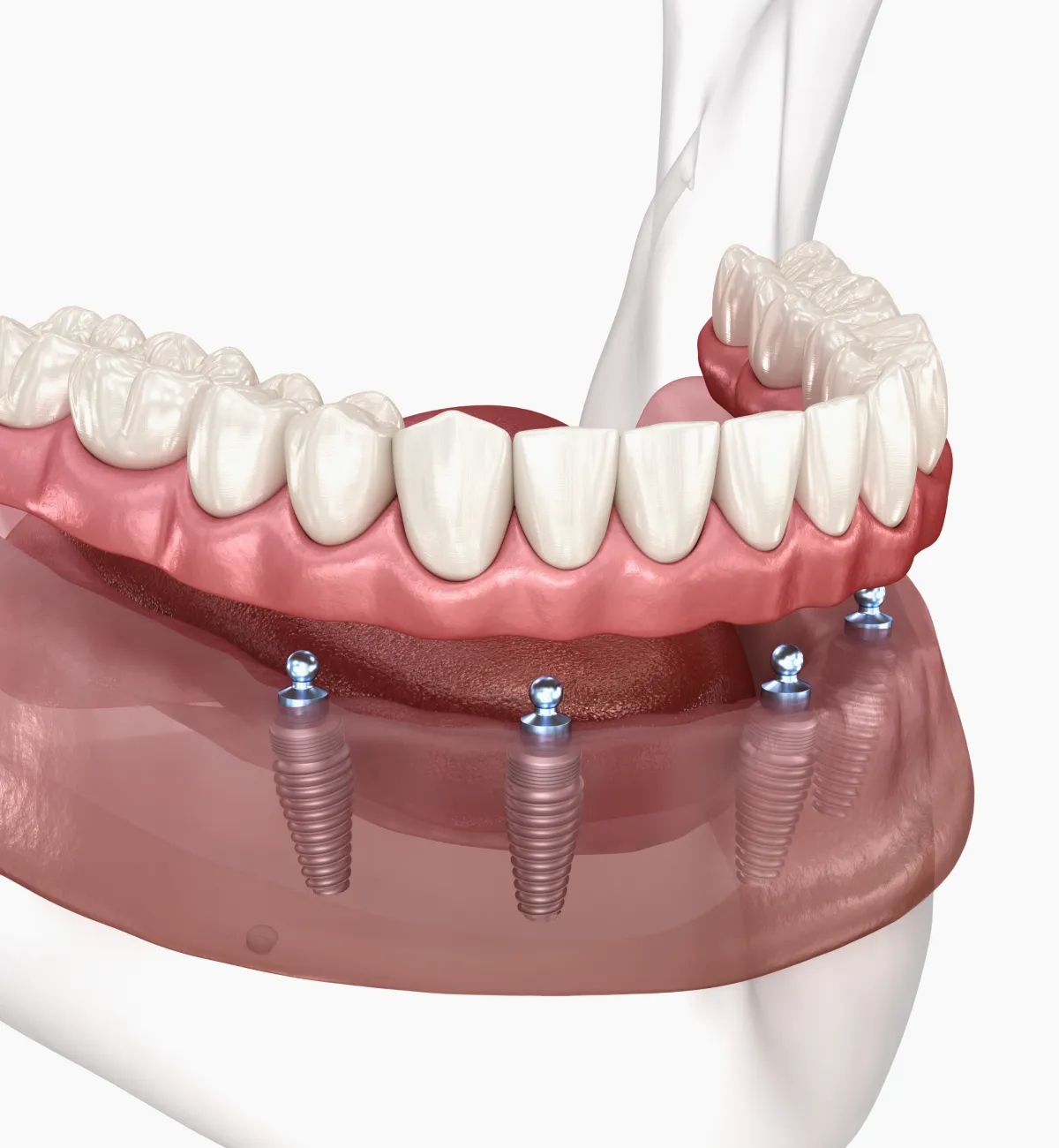 All-on-4/6とは？少ない本数で全体を支える新しい治療