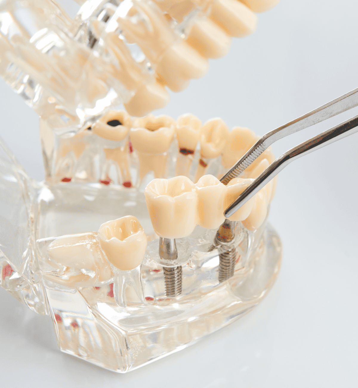 ブリッジとインプラントの違い