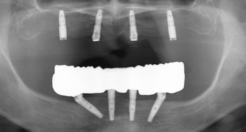 骨が足りない・他院で断られた症例も対応可能