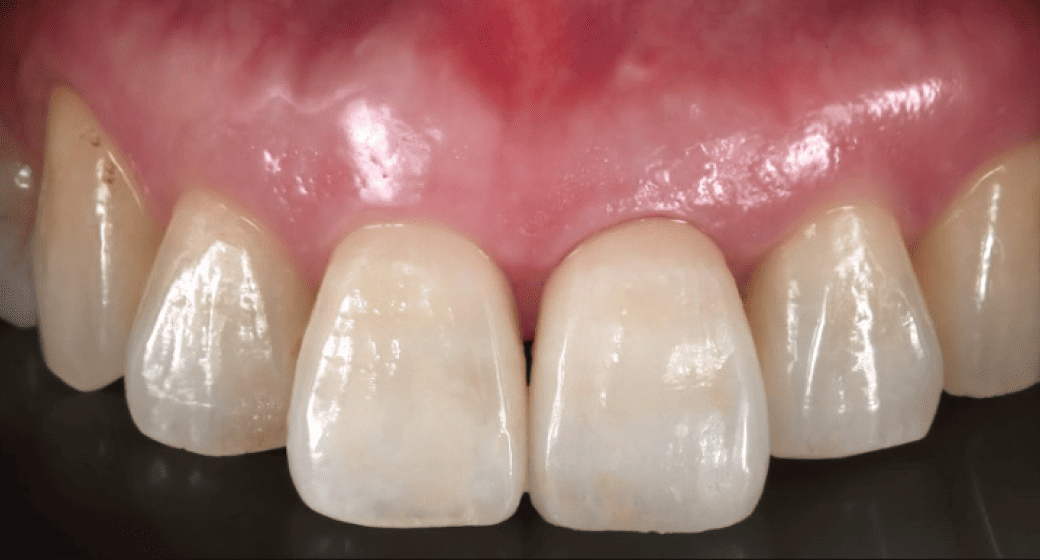 歯ぐきまで美しく自然な見た目を再現