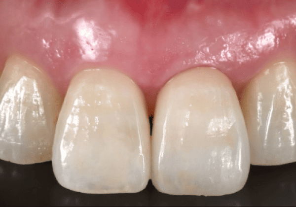 最終的な人工歯の装着