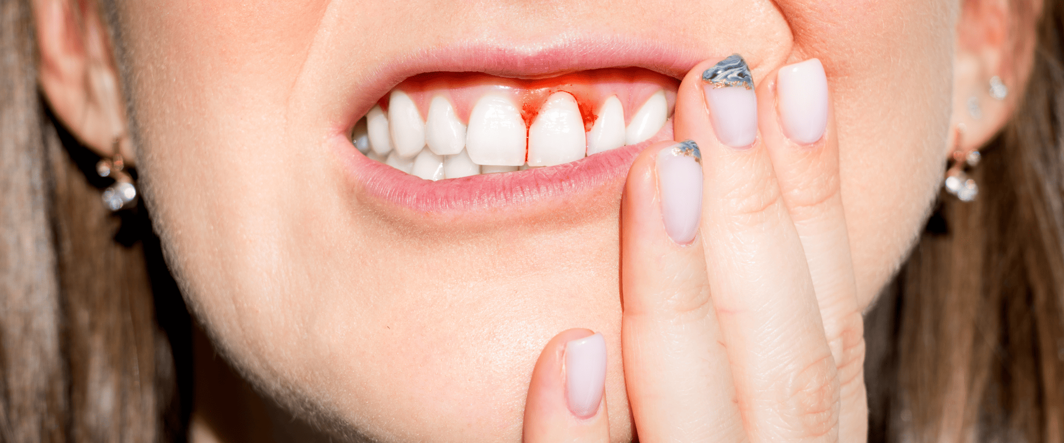 歯周病の既往がある方が注意すべきこと