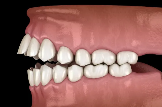 噛み合わせの調整