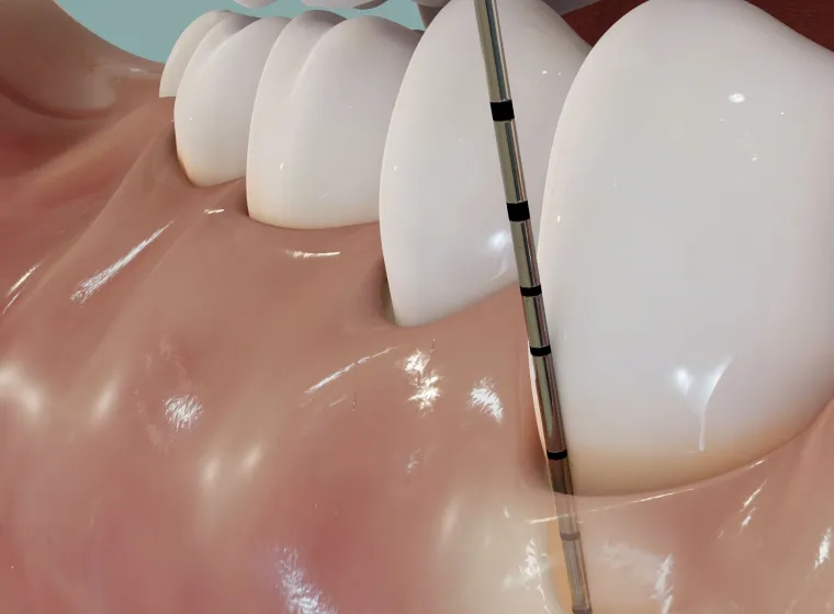 歯周ポケット検査