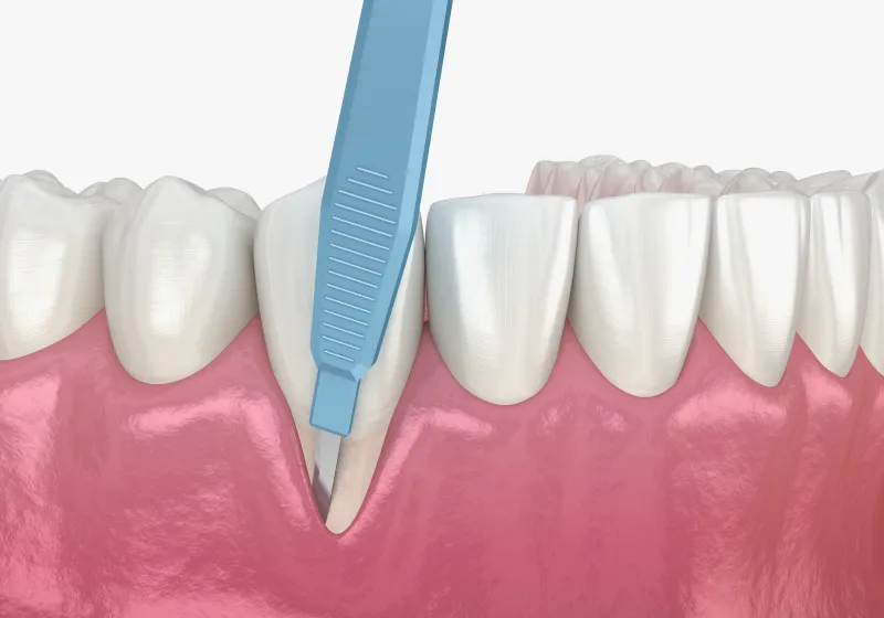 中等度以上の歯肉炎