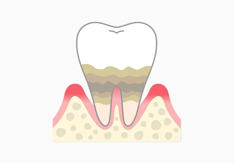 歯周炎：骨が溶けはじめる中～重度段階