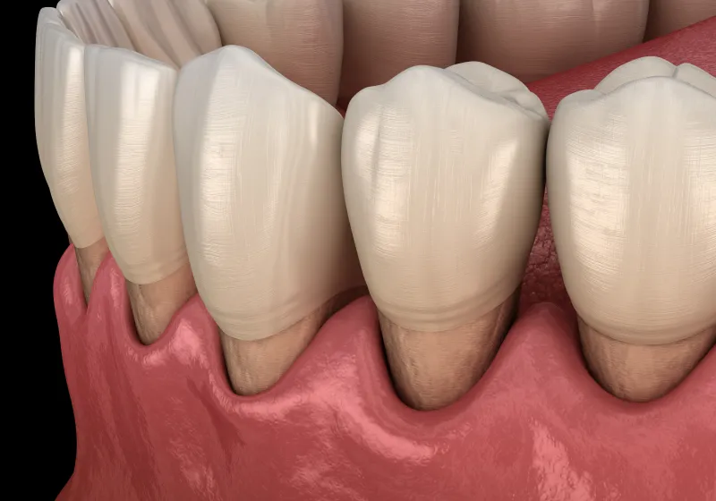歯を支える骨（歯槽骨）が溶け、最終的に歯が抜け落ちる